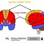 Anterior Cerebral Artery Stroke Syndrome ACA Stroke Syn