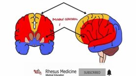 Anterior Cerebral Artery Stroke Syndrome ACA Stroke Syn