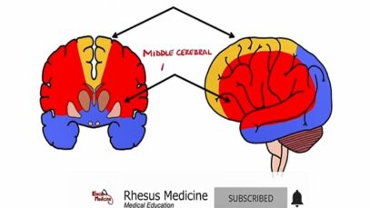 Anterior Cerebral Artery Stroke Syndrome ACA Stroke Syn