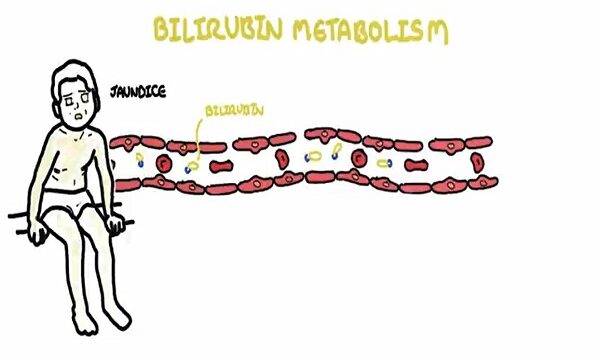 Approach to Jaundice types and causes of hyperbilirubin