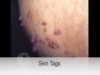 Doctor explains SKIN TAGS including CLINICAL PHOTOS