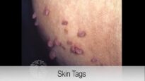 Doctor explains SKIN TAGS including CLINICAL PHOTOS