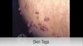 Doctor explains SKIN TAGS including CLINICAL PHOTOS