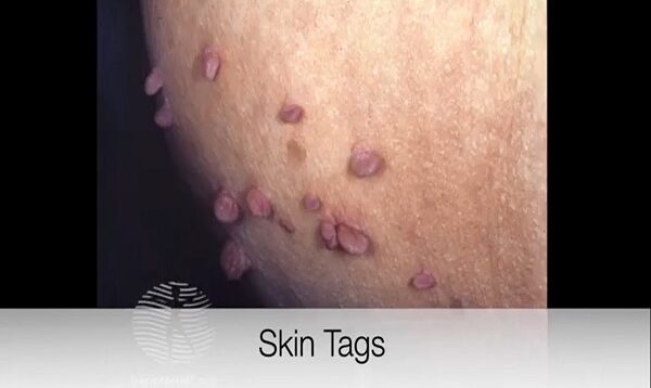 Doctor explains SKIN TAGS including CLINICAL PHOTOS