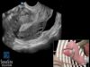 How To Pathology Ectopic Pregnancy 1st Trimester TV 3D