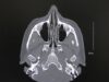 How to read a Sinus CT