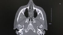 How to read a Sinus CT