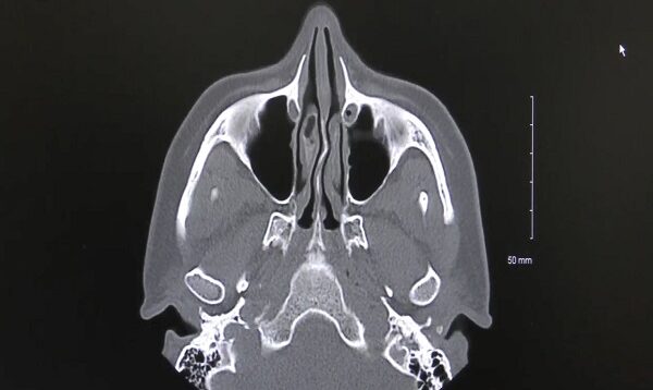 How to read a Sinus CT