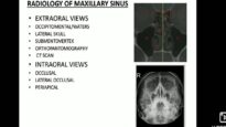 Maxillary sinus imaging and sinusitis