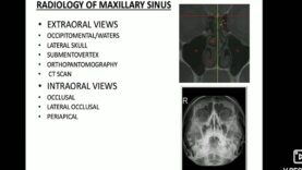 Maxillary sinus imaging and sinusitis