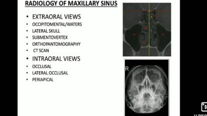 Maxillary sinus imaging and sinusitis