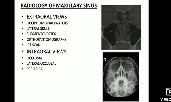 Maxillary sinus imaging and sinusitis