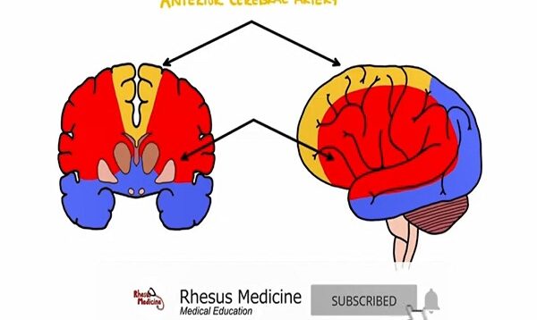 Middle Cerebral Artery Stroke Syndromes MCA Stroke Synd