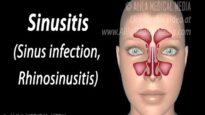 Sinusitis