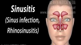 Sinusitis