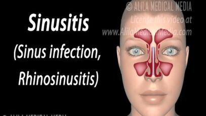 Sinusitis