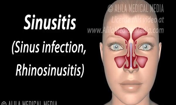 Sinusitis