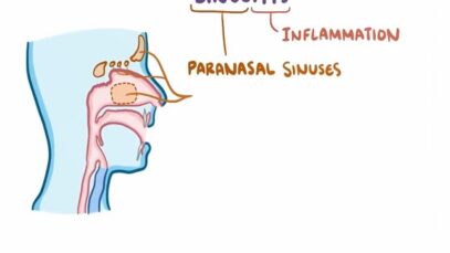 Sinusitis causes symptoms diagnosis treatment pathology