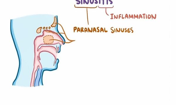 Sinusitis causes symptoms diagnosis treatment pathology