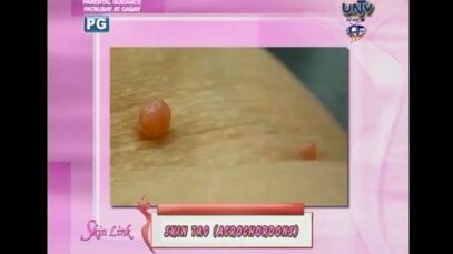 Skin Tag (Acrochordons)