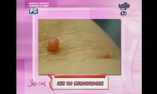 Skin Tag (Acrochordons)