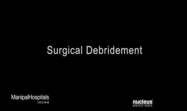 Surgical Debridement Of A Wound Best Multispeciality