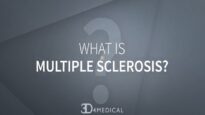 What is Multiple Sclerosis