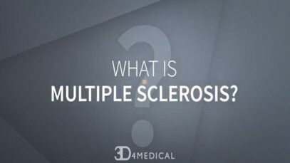 What is Multiple Sclerosis