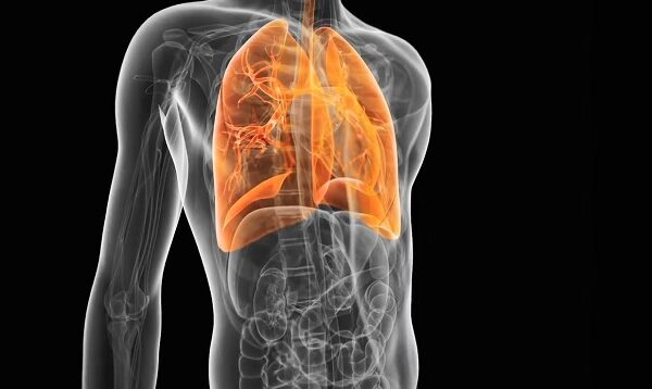 What is pneumonia.