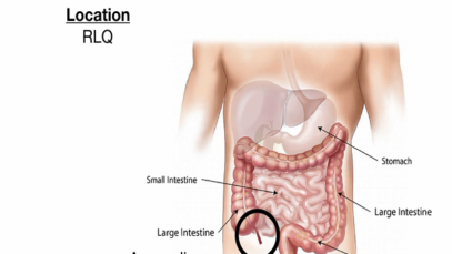 Appendicitis Signs, Symptoms, Examination, Diagnosis, Treatment [Nursing Medical]