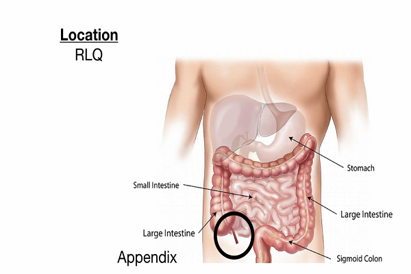 Appendicitis Signs, Symptoms, Examination, Diagnosis, Treatment [Nursing Medical]