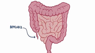 Appendicitis _ Clinical Presentation