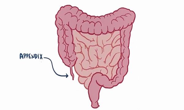 Appendicitis _ Clinical Presentation