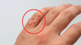 Doctor explains how to treat WARTS at home (plus when to seek medical attention)