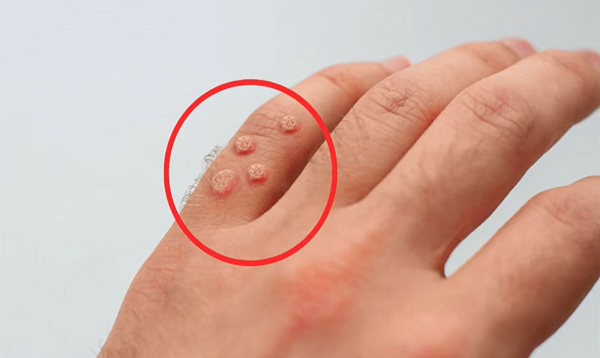 Doctor explains how to treat WARTS at home (plus when to seek medical attention)