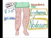 Erythema Nodosum