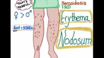 Erythema Nodosum
