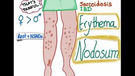 Erythema Nodosum