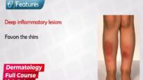 Erythema Nodosum Symptoms, Treatment, and Causes