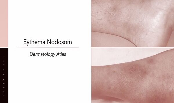 Erythema Nodosum1
