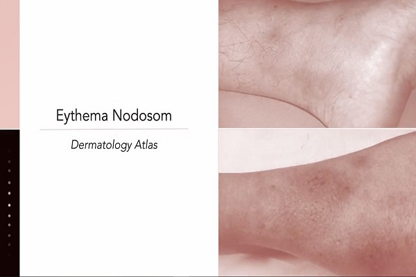 Erythema Nodosum1