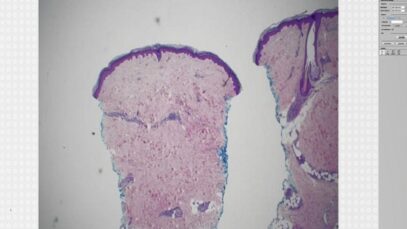 Erythema nodosum (panniculitis subcutaneous nodules fat necrosis dermatology pathology dermpath)