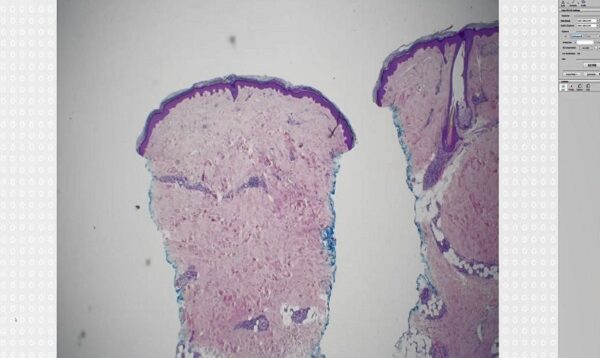 Erythema nodosum (panniculitis subcutaneous nodules fat necrosis dermatology pathology dermpath)