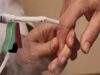 Finger Wart Cryotherapy Probe