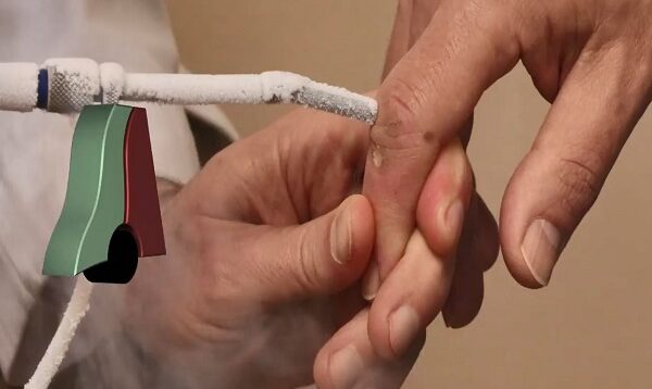 Finger Wart Cryotherapy Probe