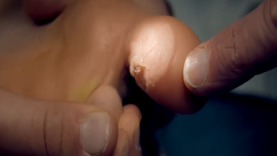 Freezing a HUGE PLANTAR WART (with liquid nitrogen)