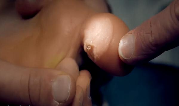 Freezing a HUGE PLANTAR WART (with liquid nitrogen)