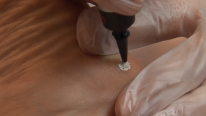 Plantar Wart Treatment