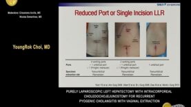 Purely laparoscopic left hepatectomy