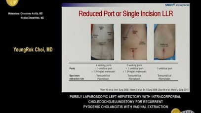 Purely laparoscopic left hepatectomy